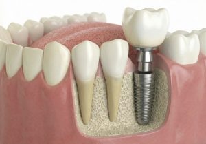 Implants dentaires