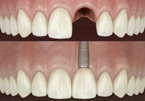 Extraction implantation immediate