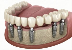 Bridge complet sur implants