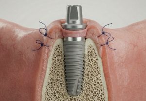 Greffe gingivale